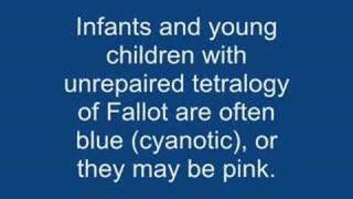 Tetralogy of fallot TOF [upl. by Toby284]