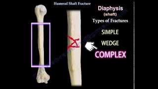 Humeral Shaft Fracture  Everything You Need To Know  Dr Nabil Ebraheim [upl. by Aztiraj]