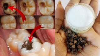 Cure tooth cavity just in one day  100 effective remedy for tooth ache  tooth pain home remedy [upl. by Hoeve942]