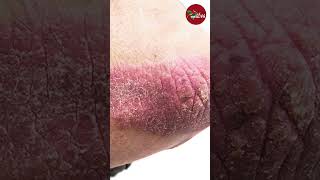 Psoriasis  Types Symptoms amp Causes  Dr Uzma Hameed  Skin Problem  Masala Health [upl. by Ashelman826]