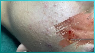 Big Cystic Acne Blackheads Extraction Blackheads amp Milia Whiteheads Removal Pimple Popping [upl. by Dzoba]