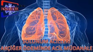 SOLUNUM ACİLLERİ  Akut Akciğer Ödemine Nasıl Müdehale Edilir [upl. by Niltyak]