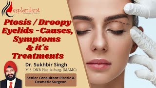 Ptosis  Droopy Eyelids Causes Symptoms and Treatment  Ptosis Surgery  Drooping Eyelid Treatment [upl. by Samuela]