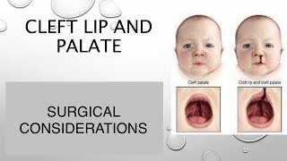 CLEFT LIP PALATESURGICAL CONSIDERATIONS dentabest4493 [upl. by Billmyre]