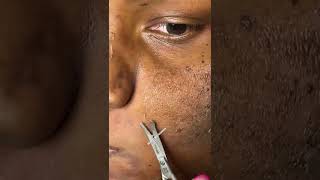 Trimming dead skin  Chemical Peel  Hyperpigmentation Removal [upl. by Atahs]