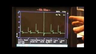 Secondary Ignition Waveforms common faults [upl. by Essex]