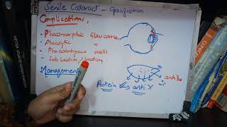 SENILE CATARACT very IMPORTANT topic ade simple part 3 [upl. by Ramso286]