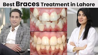 Top 5 Reasons To Get Braces From Dental Aesthetics  Tooth Talk  Dr Shahzad Mirza  Best Dentist [upl. by Elery]