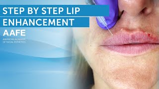 Lip Filler Tutorial  Post Care Procedure [upl. by Vevine]