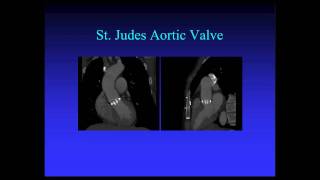 CT Imaging of Aortic Valve Part 1 [upl. by Trevor]