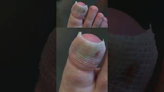 This dressing after nail surgery [upl. by Ahsyas]