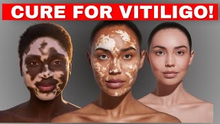 Vitiligo Skin Disease Treatment CausesTreatments  Home Remedies to cure Vitiligo Fast [upl. by Suhpesoj]