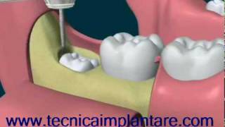 estrazione del dente del giudizio in inclusione ossea totaleflv [upl. by Zebapda]