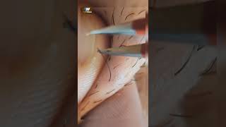 Ingrown hair removal ASMR [upl. by Selma215]