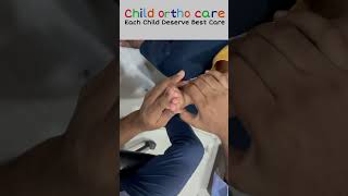 Clubfoot can correctable ll clubfoottreatment clubfoot treatment Congenital Talipes Equinovarus [upl. by Aikin909]