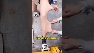 IF You Have Stretchy Skin then BEWARE😨 shorts viralvideo [upl. by Ilysa]