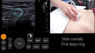 Ultrasound Tutorial InguinalFemoral Hernia Assessment  Radiology Nation [upl. by Adiam487]