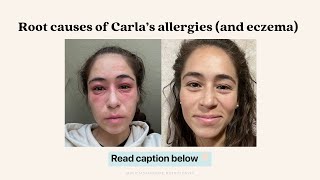 Root causes of Carlas allergies and eczema [upl. by Partan]