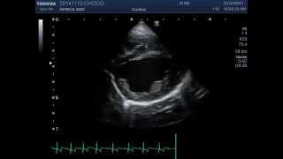 pulmonic stenosis of dog 강아지 폐동맥협착 shortaxis view [upl. by Vine]