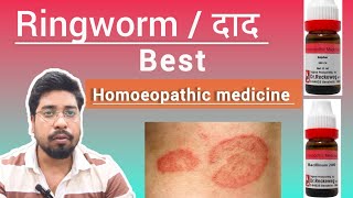 Best homoeopathic medicines for Ringworm l दाद कि होमियोपैथिक दबाई l दाद tretment l [upl. by Eladnyl]