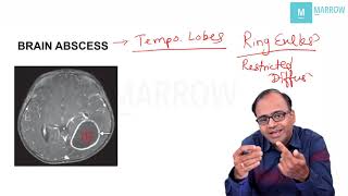 CNS  RESTRICTED DIFFUSION ON MRI amp BRAIN ABSCESS [upl. by Rambort115]