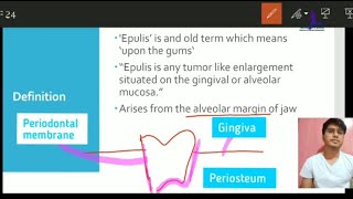 What is Epulis  EASY UNDERSTANDING OF EPULIS  Dentistry  Milestone [upl. by Aihsenad]