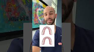 Invisalign to fix overcrowded upper teeth [upl. by Acirre]