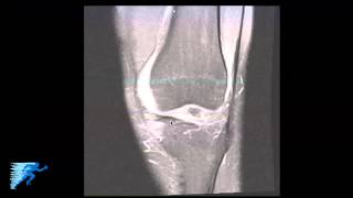 How to Read Knee MRI of Medial Meniscus Tear  Horizontal Cleavage Tear Treatment  Twin Cities MN [upl. by Enimajneb]