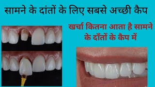 सामने के दांतों के लिए सबसे अछि कैपकैप का खर्चाTypes of dental cap and costteeth capDental cap [upl. by Eenalem]