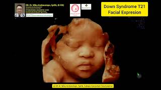 Down Syndrome 4D AI US Face Enhancement [upl. by Aonian45]