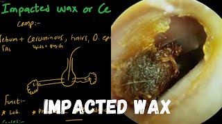 Impacted Ear Wax  Cerumen  And it’s Treatment [upl. by Peggy]