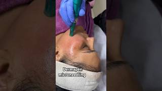 Dermapen microneedling treatment For Brightening skin👍microneedling dermapen skincare [upl. by Enyahc]