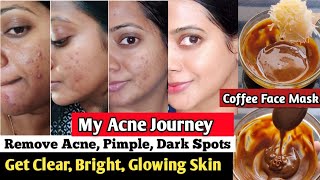 I used Coffee face pack for remove Acne pimple dark spots free skin coffee face mask skin whitening [upl. by Tak]