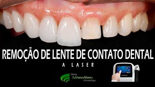 Remoção de lentes de contato dental a laser  Fortaleza  CE [upl. by Farnham]