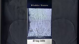 xray KUB  Bladder Stones  radiological xray xraytechnician [upl. by Erikson]