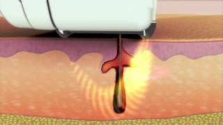 Hair Removal Technology Animation [upl. by Aneelehs]