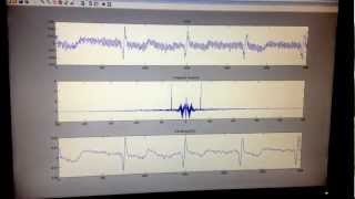 ECG signal filtering and noise reduction with MATLAB realtime result only no code [upl. by Assirrak831]