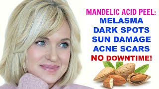 MANDELIC ACID PEEL MELASMA DARK SPOTS HYPERPIGMENTATION SUN DAMAGE amp ACNE Skincare Over 50 [upl. by Notnilk]