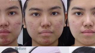 Lutronic Spectra amp Gold Toning Laser Treating Acne amp Redness at BeauampHans Aesthetic [upl. by Esinyl396]