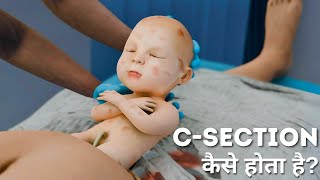 CSection क्यों और कैसे किया जाता है  Reasons for CSection Procedure and Recovery3D Animation [upl. by Spark158]