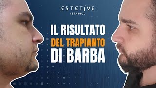 IL RISULTATO DEL TRAPIANTO DI BARBA [upl. by Brainard]