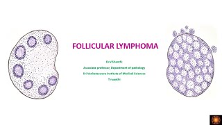 FOLLICULAR LYMPHOMA  PATHOGENESIS MORPHOLOGY AND PROGNOSTIC FACTORS  DRV SHANTHI [upl. by Joelly]