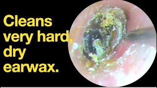 Cleans very hard dry earwax ear wax removal  ear cleaning  ASMR  relaxation  relax [upl. by Hoffer]