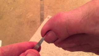 Another ingrown toenail fixed in less than 2 minutes [upl. by Tansy]