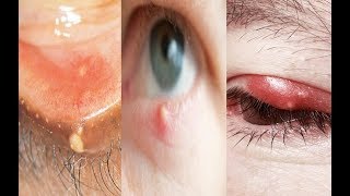 Hordeolum vs chalazion vs blepharitis [upl. by Joana364]