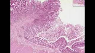 Histopathology ColonAdenocarcinoma [upl. by Crystal]