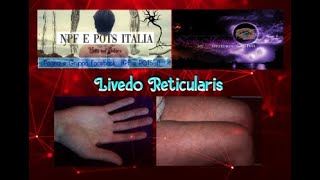 Livedo Reticularis  Cosa è [upl. by Itisahc]