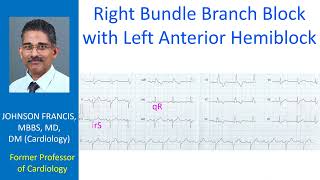 Right bundle branch block with left anterior hemiblock [upl. by Dian]