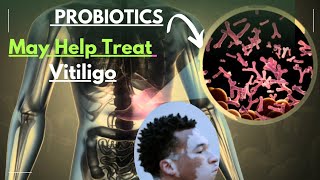 How Probiotics May Help Treat Vitiligo Naturally [upl. by Llevaj498]