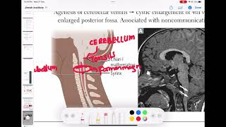 chiari 1 malformation neurology 7  First Aid USMLE Step 1 in UrduHindi [upl. by Ainirtac262]